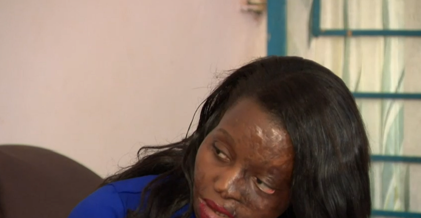 Preživjela je napad kiselinom: "Užasno je,  kao da ti netko kopa ispod kože"